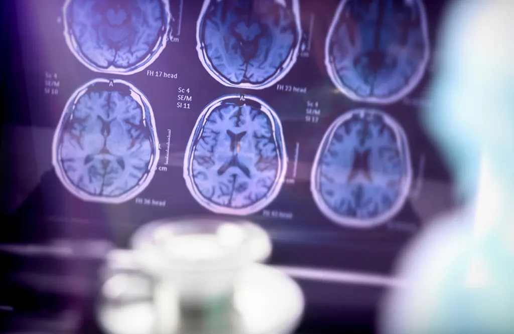 Demencja 3 demencja 3